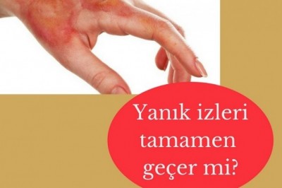 Yanık dereceleri nelerdir? Yanıkta ilk müdahale ve tedavisi