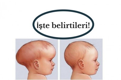 Hidrosefali (gün batımı sendromu) nedir nasıl tedavi edilir?