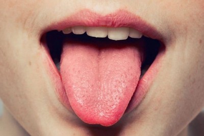 Dil felci (glossopleji) neden olur? Dil felci belirtileri ve tedavisi
